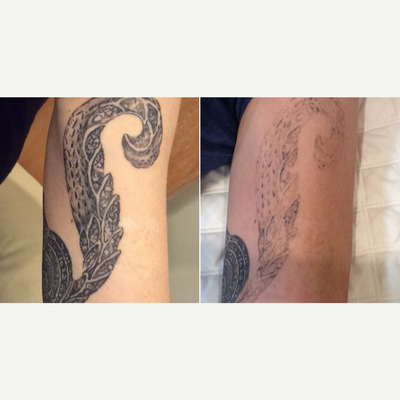4 Treatment Tattoo Removal - Just 4 treatments for dramatic results on this black arm tattoo.