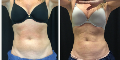 45-54 year old woman treated with Coolsculpting and CoolTone - Coolsculpting - Treated on Abdomen and FlanksCooltone - Treated Abdomen - 6 treatments 2x/week
