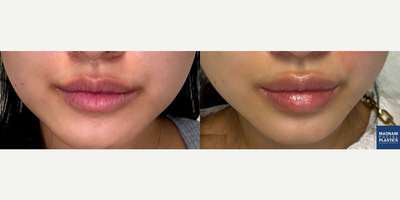 Woman treated with Restylane Kysse - Woman treated with 1 syringe ofRestylane Kysse