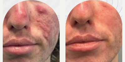 Man treated with AviClear - Man treated with AviClear