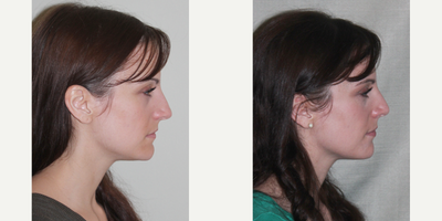 25-34 year old woman treated with Sinus Surgery - Female patient 3 months out from Vestibular Stenosis, Turbinate Reduction, Septoplasty procedure.