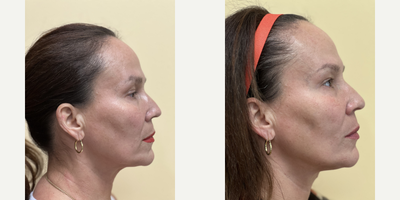 55-64 year old woman treated with Contour Thread Lift - PDO threads stimulate collagen and aims to lift, reshape, and redefine the contour of the face, brows, eyes, jawline, jowls, and cheek areas.