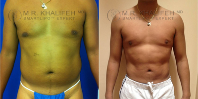 35-44 year old man treated with Liposculpture - Asian Liposuction patienthad liposuction of abdomen and lower back/flank (lovehandle) lipo to accentuate his athletic body.