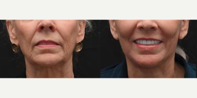 75 and up year old woman treated with Facelift, Facelift Revision, Neck Lift, Laser Resurfacing, Facial Fat Transfer - Updates on this wondeful patient now 6 weeks out from a revision face and neck lift with fat transfer and laser resurfacing. She is healing beautifully and loving her results!
