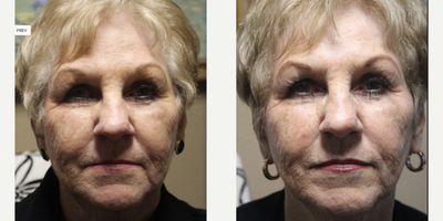 75 and up year old woman treated with Vampire Facelift - Vampire Facelift using PRP and dermal fillers.