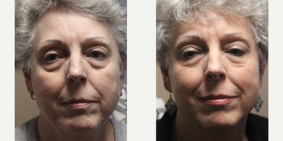 65-74 year old woman treated with Vampire Facelift  - Vampire Facelift using PRP and dermal fillers.