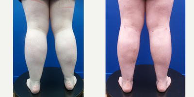 18-24 year old woman treated with Calf Reduction - 24-year-old lady underwent Power & Laser-assisted Liposuction of the Calves, Ankles & Lateral Feet.