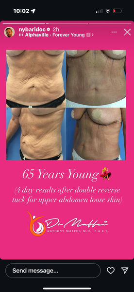 Exceptional Dr and Results - double reverse tummy tuck and Vaser Lipo on my  neck.