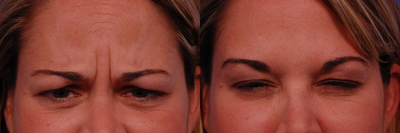 35-44 year old woman treated with Dysport - treatment areas include: glabella, crows feet, and forehead. - 40 year old female with Dysport treaments to the glabella, crows feet, and forehead.