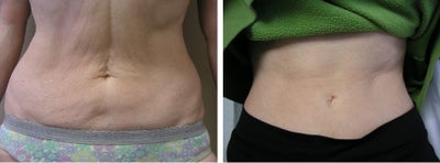 Thermage Skin Tightening for the Abdomen - Noticeably less sagging in the skin after having Thermage treatment on the abdomen.