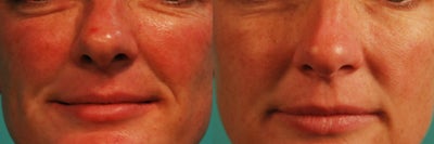 Female treated for skin redness - Laser Genesis to treat overall redness of the skin