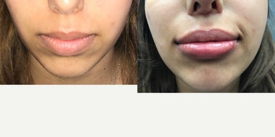 25-34 year old woman with already nice lips that we treated with Lip Augmentation - Lips are HOT right now. This young woman is no exception! We also did some chin and jawline fillers to help define these areas and frame the lips.Best,DrC