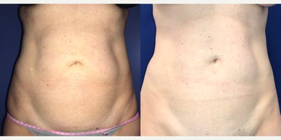 45-54 year old woman treated with Liposuction - Patient is 8 months post op liposuction
