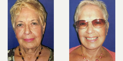 65-74 year old woman treated with Neck Lift - When this patient came to see me for a consultation, her energy and passion for life was immediately apparent. She is a woman who not only wanted her appearance to match how she felt on the inside, but also for it to radiate. I created a treatment plan for her which involved a SMAS facelift, neck lift (platysmaplasty), and conservative lipo-sculpting.