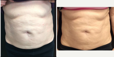 55-64 year old woman treated with UltraShape Power - UltraShape power uses focused ultrasound technology to deliver energy to subcutaneous fat which vibrates the fat cell walls to cause them to burst without any pain, without any signs of treatment and without any downtime. Treatment is a series of 3 treatments 2 weeks apart.