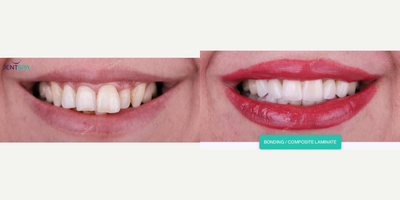 45-54 year old man treated with Dental Bonding - -