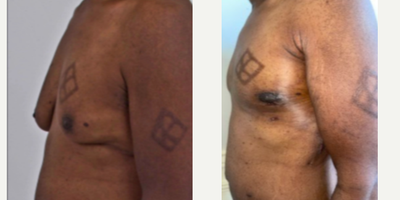 35-44 year old man treated with Gynecomastia Surgery - Struggling with the discomfort and embarrassment of gynecomastia? Dr. Meegan Gruber's gynecomastia reduction w/ no chest scar can help you achieve a more masculine, toned chest. The before and after photos of Dr. Gruber's patients speak for themselves - this procedure can make a life-changing difference in the contours of your chest, giving you the confidence to take on the world. Trust Dr. Gruber's expertise and experience to give you the results you deserve. Book your appointment today and start feeling like the best version of yourself!