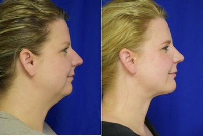 Chin Implant New Orleans - Chin Implant in New Orleans woman along with Primary Rhinoplasty and liposuction by Facial Plastic Surgery Specialist, Dr. Sean Weiss in Metairie, Louisiana