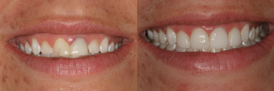 Simple Smile Design with gum lift and porcelain veneers - Patient is a college-aged female who wanted to improve her smile.&nbsp; Her main concerns:&nbsp; gummy smile and small teeth.Treatment:&nbsp; gum lift, whitening,&nbsp;and 4 porcelain veneers&nbsp;