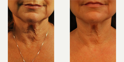 Woman treated with Skintyte - Woman treated with Skintyte