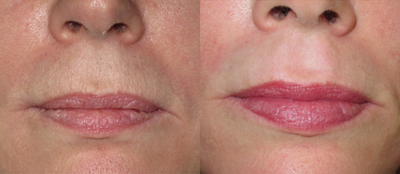 45-54 year old woman treated with CO2 Laser - Fractional carbon dioxide laser to the upper lip.