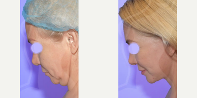 Woman treated with Facelift - Her smile without a doubt reflects the satisfaction and happiness obtained with the results of her procedure.Procedure: Complete Ritidectomy
