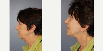 65-74 year old woman treated with Neck Lift - 65 year old undergoing necklift