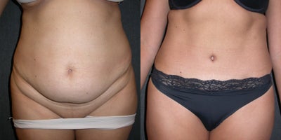 Woman treated with Tummy Tuck - This 41 year old woman complained of excess abdominal skin and fat, with a severely protruding tummy. An abdominoplasty, or tummy tuck, dramatically improved her shape.