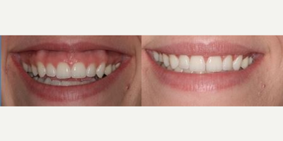 35-44 year old woman treated with Lip Lowering - This patient's gummy smile was treated with upper lip lowering so the upper lip appears to be more full.