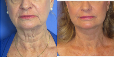 65-74 year old woman treated with Facelift - 68 year old female seeking rejuvenation of her lower face and specifically jowls, jawline, and neck. She had a lower face and neck lift under local anesthesia and oral sedation.