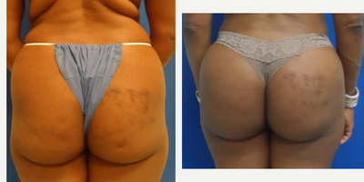 Woman treated with Brazilian Butt Lift - Woman treated with Brazilian Butt Lift