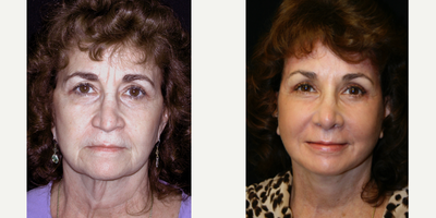 55-64 year old woman treated with Deep Plane Facelift, Facial Fat Transfer, Laser Resurfacing, Rhinoplasty, Lip Repositioning - This patient had total facial rejuvenation .