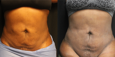 25-34 year old woman treated with Tickle Lipo - Patient had 2 previous liposuctions and one smart lipo and was not happy with her results and wanted her abdomen more even.