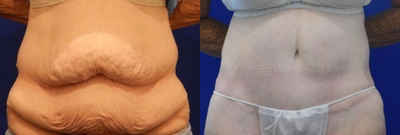 Woman treated with Panniculectomy - Woman treated with Panniculectomy
