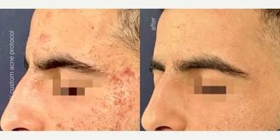Man treated with AviClear, Skin Rejuvenation - Consistency is Key!We are excited to share the remarkable journey of one of our patients who was determined to overcome persistent acne.Starting with AviClear, followed by custom laser treatments, and complemented with monthly Diamond Glow sessions with Chloe, the transformation has been incredible.The results truly speak for themselves. Remember, achieving great outcomes takes time. Trust the process.