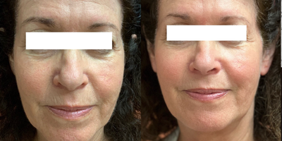 55-64 year old woman treated with Opus Plasma - Patient presented with texture issues and wanted rejuvenation with skin tightening. Opus helped to define her jawline and reduce lines and wrinkles.