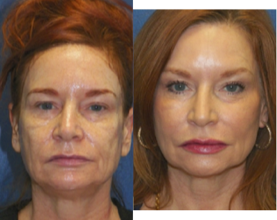 55-64 year old woman treated with CO2 Laser - This is a picture of before CO2, The inbetween stage of CO2 ( 2 days after), and After Smartskin CO2 (1 month)Smartskin CO2 can be treated in as little as 15-30 mins, with results lasting years, with proper skin care and protection.