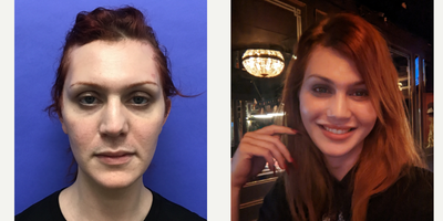 Patient treated with Cheek Augmentation - Cheek Implants (small) - 25 to 34 year-old female patient is 1 month post-op from Facial Feminization surgery. Her procedures included: Forehead Lift, Hairline Lowering, Orbital Bony Contouring, Septorhinoplasty Revision (closed) with Cartilage Grafts, Cheek Implants (small), Chin Reduction and Contour, Soft Tissue to Nasolabial Folds, Intranasal Lip Lift with Fat Augmentation, Thyroid Cartilage Shave Revision and Voice Feminization and 300 Micrografts.