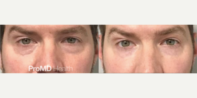 Man treated with Dermal Fillers, Sculptra, Hyaluronidase - Man treated with Dermal Fillers, Sculptra, Hyaluronidase