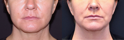 45-54 year old woman treated with Lip Implants - 46 year old female received a lip augmentation with PermaLip implant; photos depict the patient's results 3 months post-op.