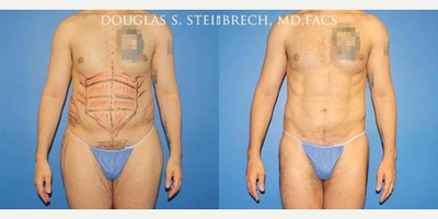 Man treated with Butt Augmentation - Man treated with Butt Augmentation