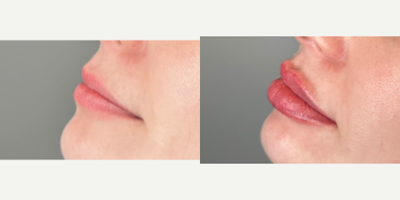 25-34 year old woman treated with Revanesse, Lip Fillers - 1cc of Versa to the lips