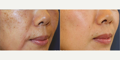 Woman treated with Enlighten - Woman treated with Enlighten
