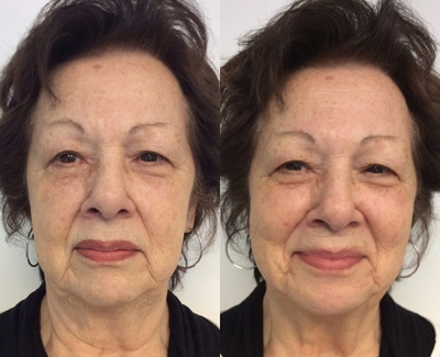Woman treated with Dermaplaning - Woman treated with Dermaplaning