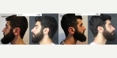 25-34 year old man treated with Rhinoplasty - Nose Job - 2 Monts post-op