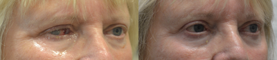 Prosthetic Eye - 70+ year old woman, underwent right eye removal (evisceration) followed by prosthetic fake eye placement by ocularist.