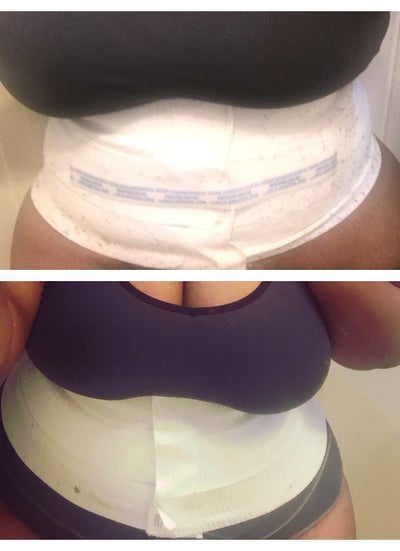 Plus size: Extended Tummy tuck with lipo on flanks - Review - RealSelf