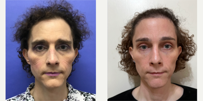 Patient treated with Septoplasty, Rhinoplasty, Voluma, Juvederm - Septorhinoplasty (closed) with Cartilage Grafts and Weirs, 2cc - 35 to 44 year-old female patient is 6 months post-op from Facial Feminization surgery. Her procedures included: Forehead Lift and Orbital Bony Contouring, Septorhinoplasty (closed) with Cartilage Grafts and Weirs, Chin Reduction and Contour, Soft Tissue to Nasolabial Folds, Intranasal Lip Lift with Fascia to Lips, Thyroid Cartilage Shave and Voice Feminization, 2cc Voluma to Cheeks, and 400 Micrografts to Recessions.