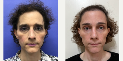 35-44 year old transgender woman treated with Facial Feminization Surgery, Transgender Facial Feminization Surgery - 35 to 44 year-old female patient is 6 months post-op from Facial Feminization surgery. Her procedures included: Forehead Lift and Orbital Bony Contouring, Septorhinoplasty (closed) with Cartilage Grafts and Weirs, Chin Reduction and Contour, Soft Tissue to Nasolabial Folds, Intranasal Lip Lift with Fascia to Lips, Thyroid Cartilage Shave and Voice Feminization, 2cc Voluma to Cheeks, and 400 Micrografts to Recessions.