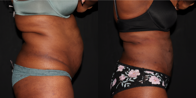 45-54 year old woman treated with Skin Tightening - Liposuction to abdomen and flanks with Renuvion skin tightening to abdomen.